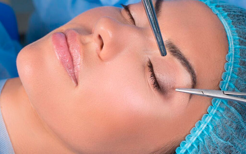 Blefaroplastia Blefaroplastia
